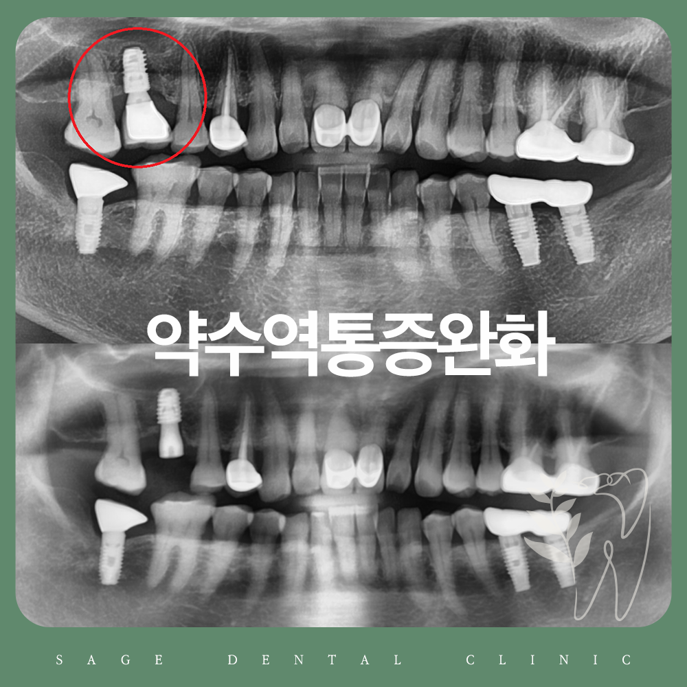 약수역통증완화
