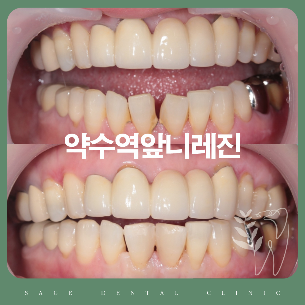 약수역앞니레진