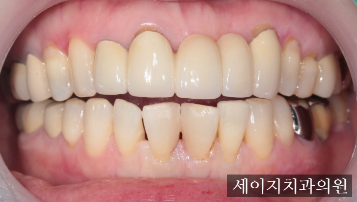 약수역앞니레진