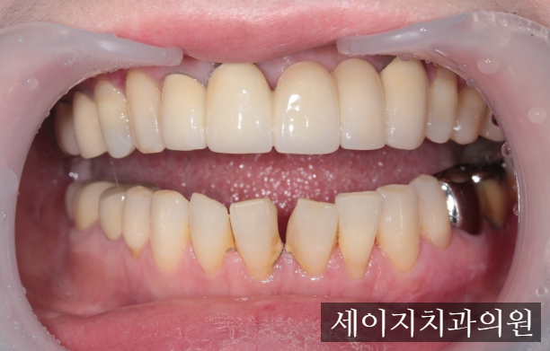 약수역앞니레진