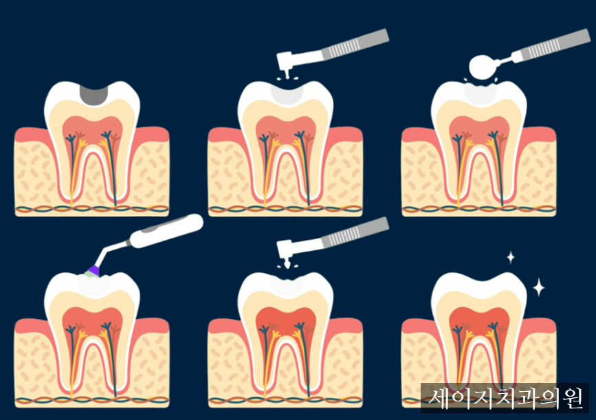 약수역앞니레진