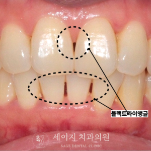 약수역신경치료