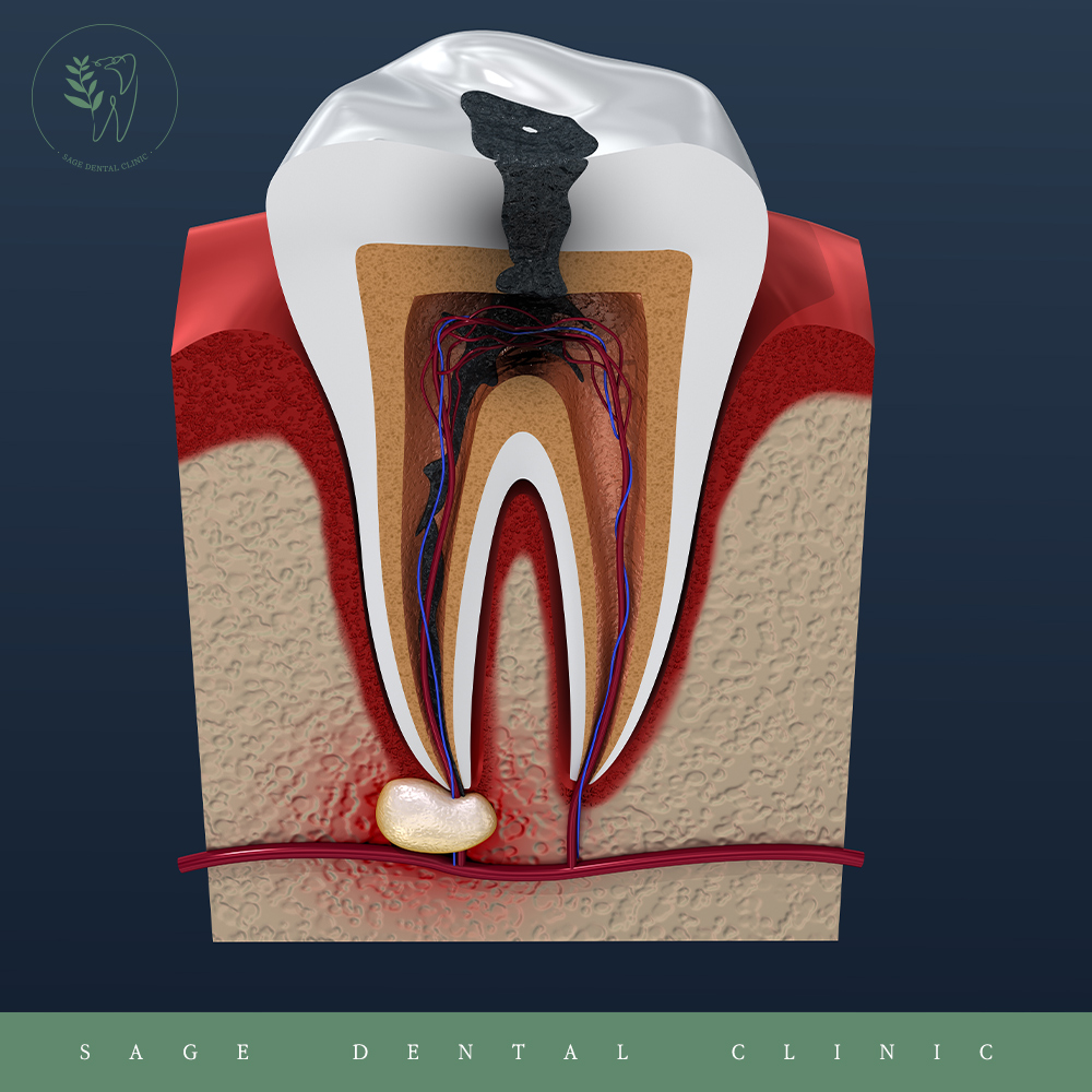 신당동충치치료