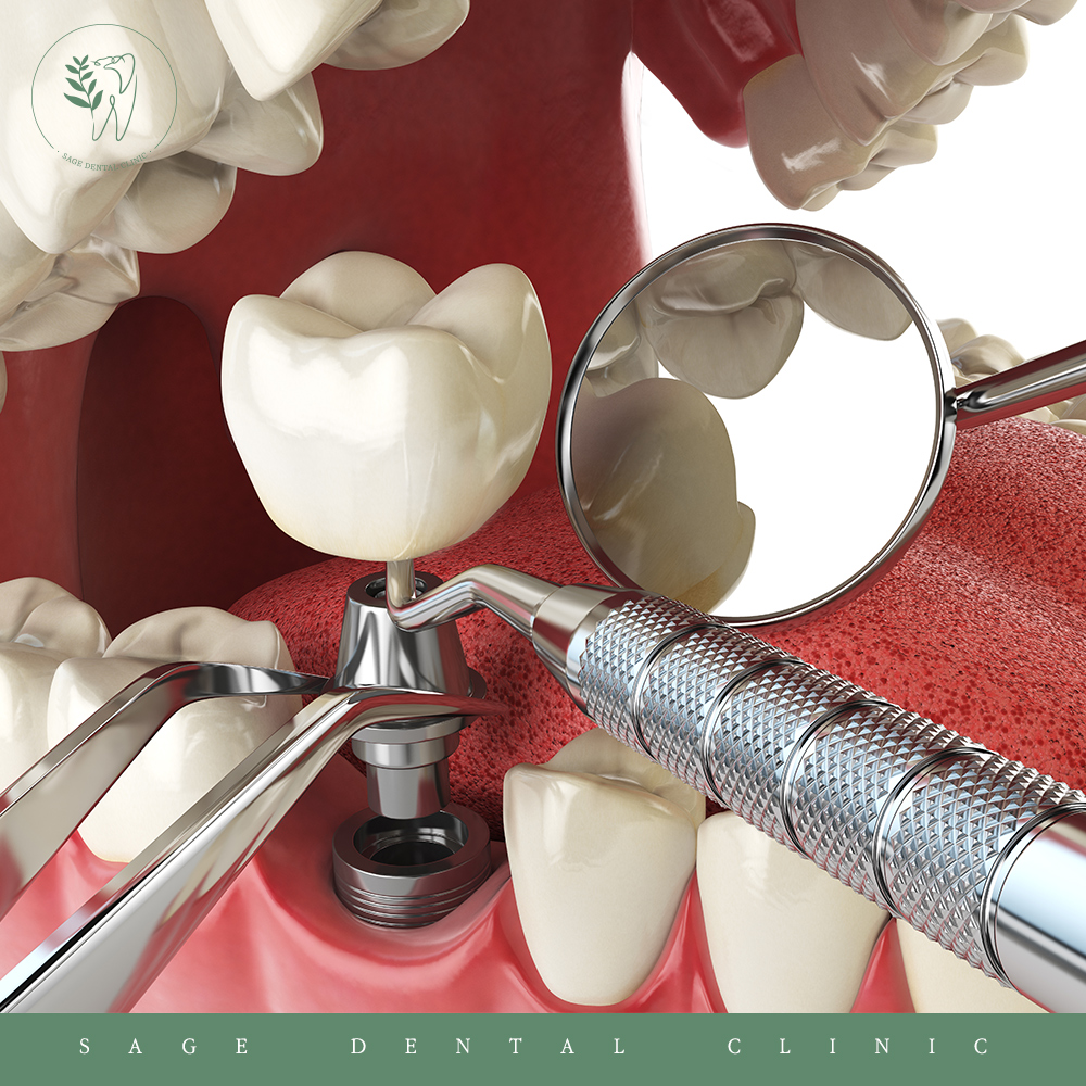 신당동충치치료