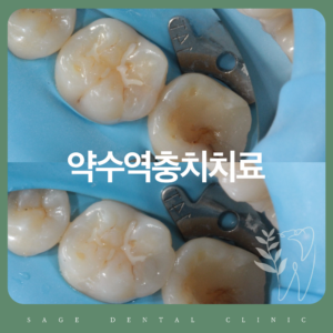 약수역충치치료