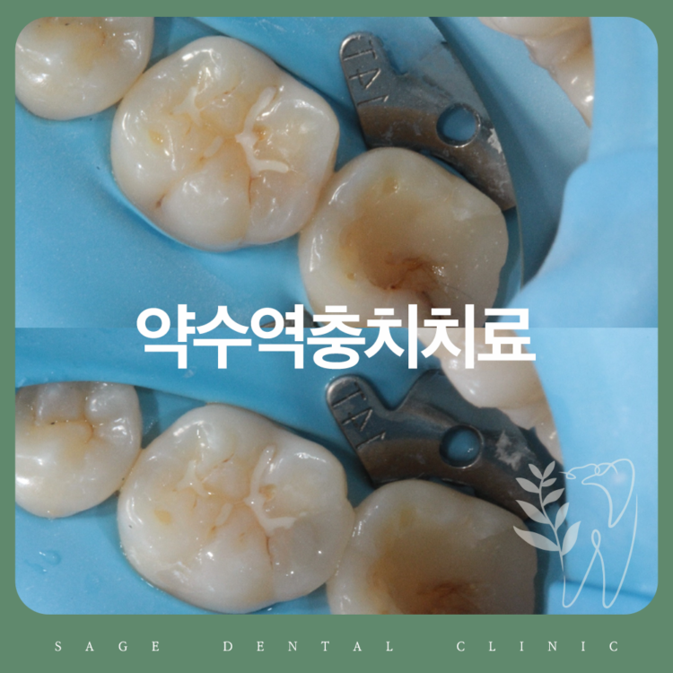 약수역충치치료