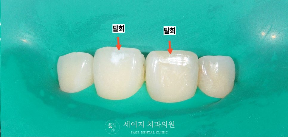 신당동레진치과