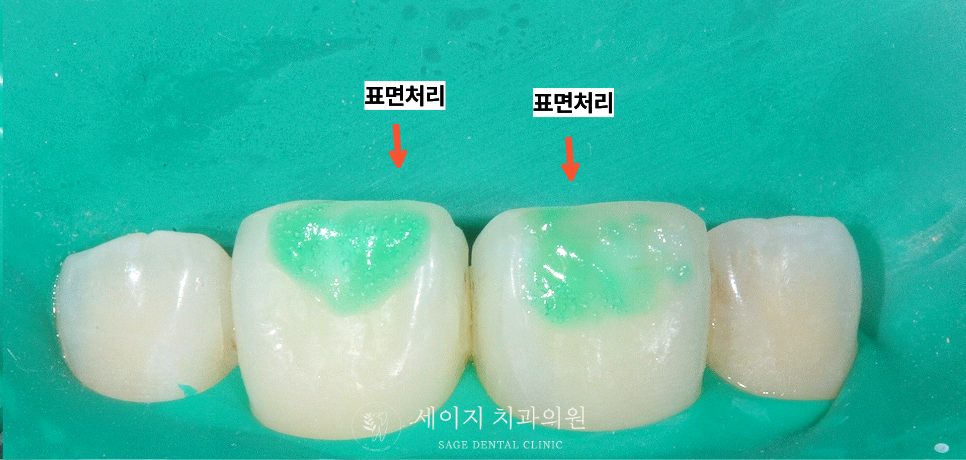 신당동레진치과