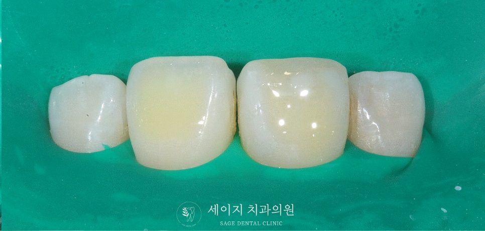 신당동레진치과