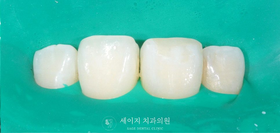 신당동레진치과